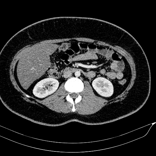 Acute on chronic pancreatitis (Radiopaedia 80902-94423 Axial C+ portal venous phase 88).jpg