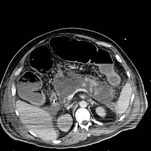 Acute pancreatic necrosis (Radiopaedia 13560-18501 Axial C+ portal venous phase 46).jpg