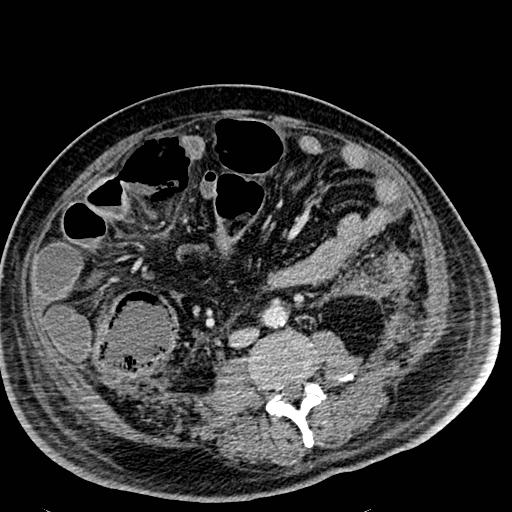 Acute pancreatic necrosis (Radiopaedia 13560-18501 Axial C+ portal venous phase 83).jpg