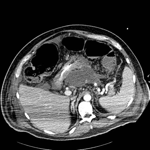 File:Acute pancreatic necrosis (Radiopaedia 13560-18502 Axial C+ portal venous phase 15).jpg