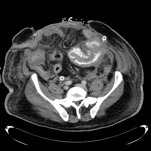 Acute pancreatic necrosis (Radiopaedia 13560-18503 Axial C+ portal venous phase 58).jpg