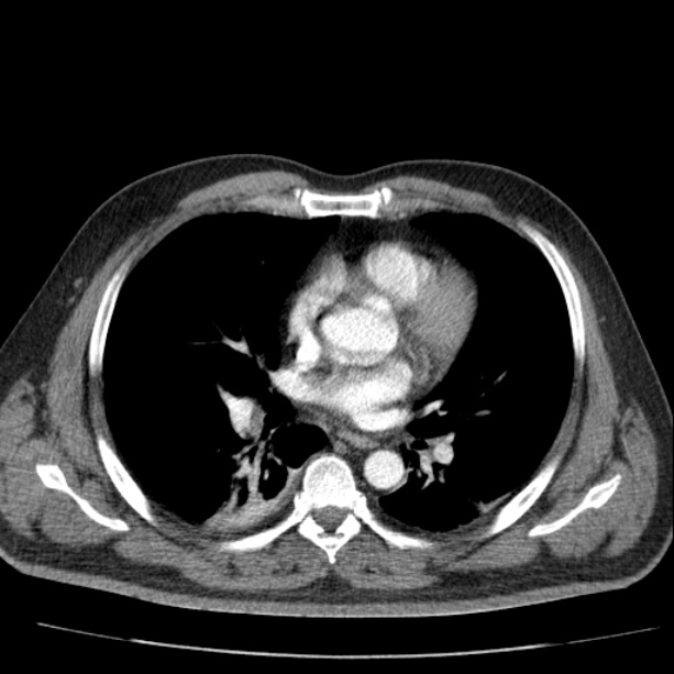 Acute pancreatitis (Radiopaedia 26663-26813 Axial C+ arterial phase 4).jpg