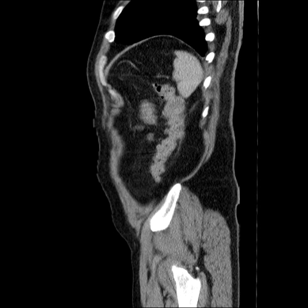 Acute pancreatitis (Radiopaedia 26663-26813 Sagittal C+ portal venous phase 65).jpg