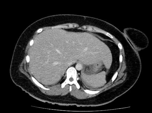 Acute pancreatitis (Radiopaedia 69236-79012 Axial C+ portal venous phase 16).jpg