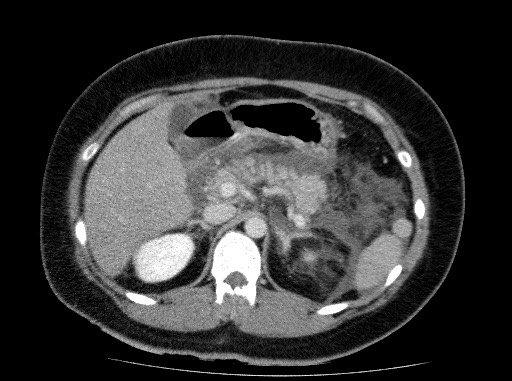 Acute pancreatitis (Radiopaedia 69236-79012 Axial C+ portal venous phase 30).jpg