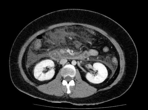 Acute pancreatitis (Radiopaedia 69236-79012 Axial C+ portal venous phase 41).jpg