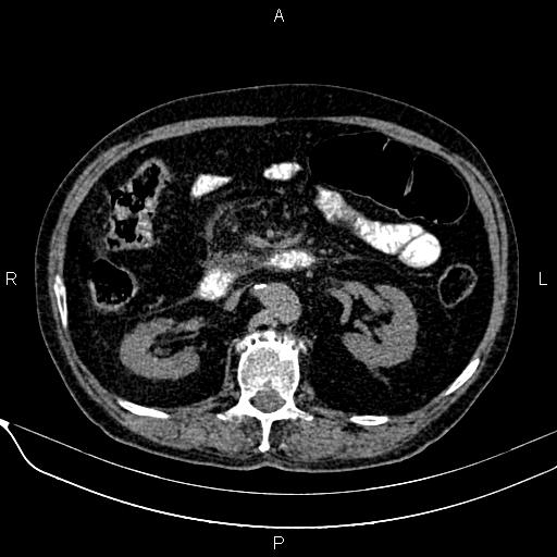 Acute pancreatitis (Radiopaedia 85146-100701 Axial non-contrast 54).jpg