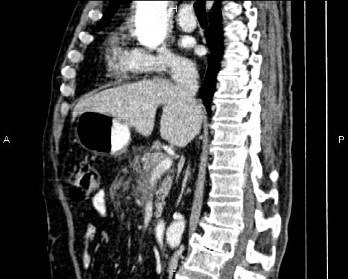File:Acute pancreatitis (Radiopaedia 85146-100701 Sagittal C+ portal venous phase 43).jpg