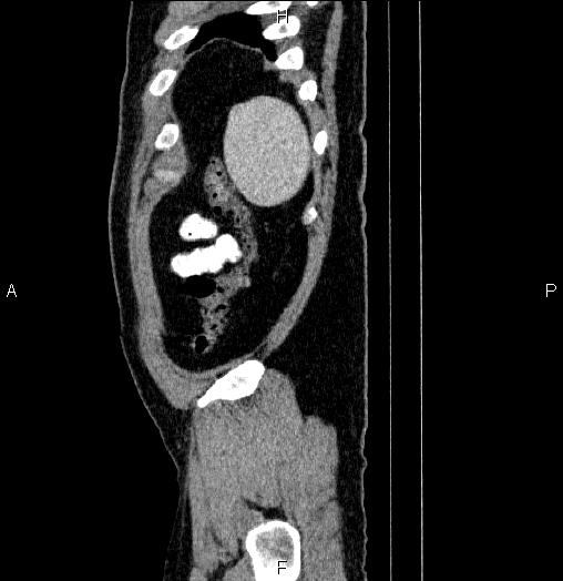 File:Acute pancreatitis (Radiopaedia 85390-101010 Sagittal C+ portal venous phase 97).jpg