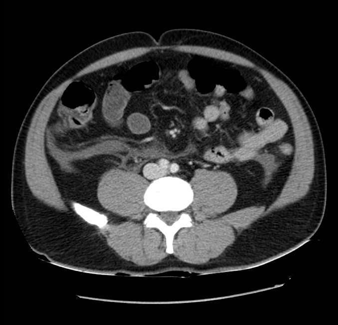 Acute pancreatitis - Balthazar E (Radiopaedia 23080-23110 Axial C+ portal venous phase 43).jpg