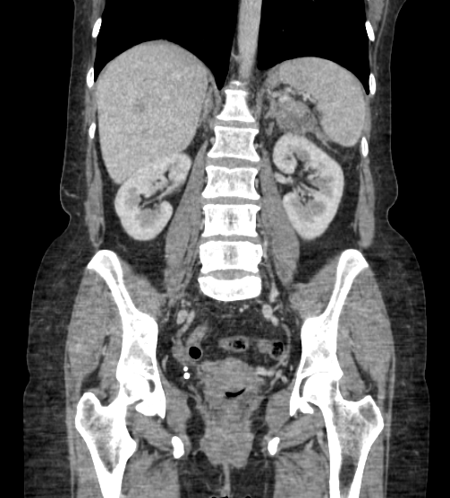 Acute pancreatitis - Balthazar E - post ERCP (Radiopaedia 27562-27772 Coronal C+ portal venous phase 55).png
