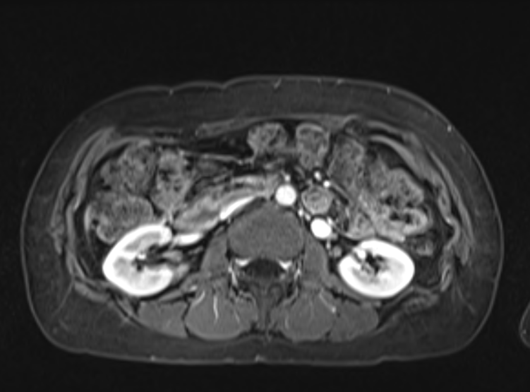 Acute pancreatitis - Balthazar E - post ERCP (Radiopaedia 27562-27778 F 59).png