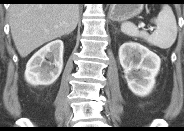 File:Acute pancreatitis and walled-off necrosis (Radiopaedia 29888-30403 Coronal C+ portal venous phase 40).jpg
