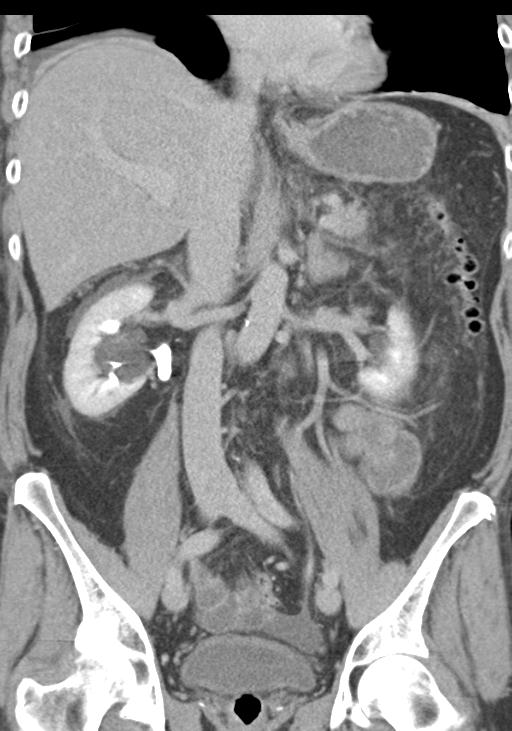 Acute pancreatitis and walled-off necrosis (Radiopaedia 29888-30403 E 32).jpg