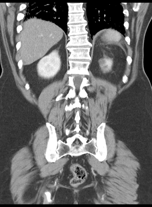 Acute pancreatitis complicated by portal vein thrombus (Radiopaedia 48148-52990 Coronal C+ portal venous phase 49).png