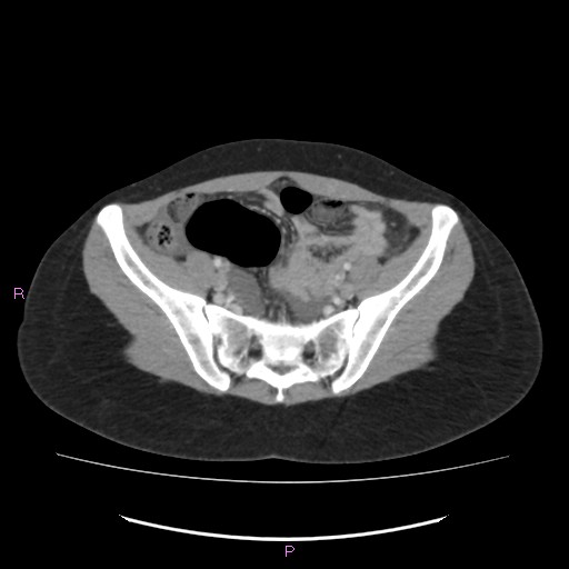 Acute pancreatitis secondary to stone at minor papilla and pancreatic divisum (Radiopaedia 76570-88333 Axial C+ portal venous phase 61).jpg