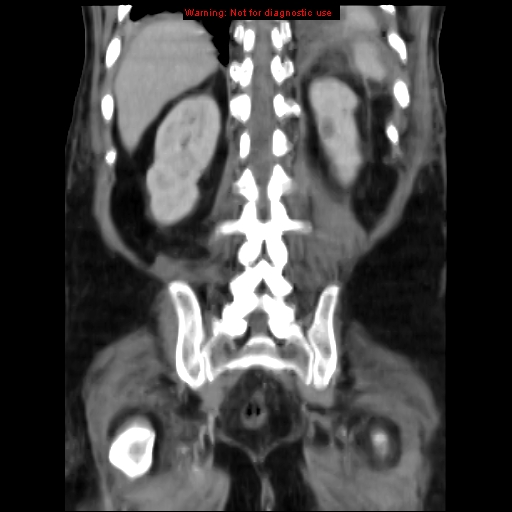Acute pancreatitis with incidental pancreatic lipoma (Radiopaedia 10190-10730 Coronal C+ portal venous phase 58).jpg