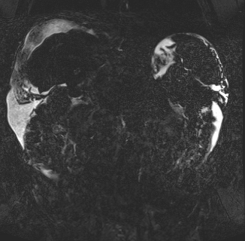 Acute portal vein thrombosis (Radiopaedia 73198-83925 Coronal Heavily T2 thin cuts 56).jpg
