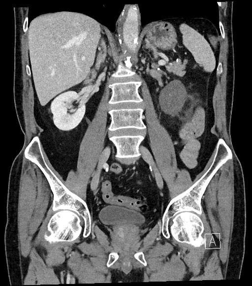 Acute renal infarction (Radiopaedia 59375-66736 Coronal C+ portal venous phase 36).jpg