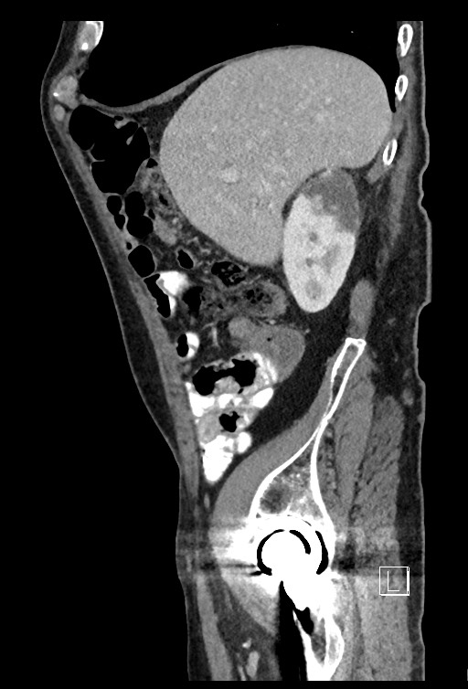 Acute renal infarction - rim capsular enhancement (Radiopaedia 59833-67270 Sagittal C+ portal venous phase 69).jpg