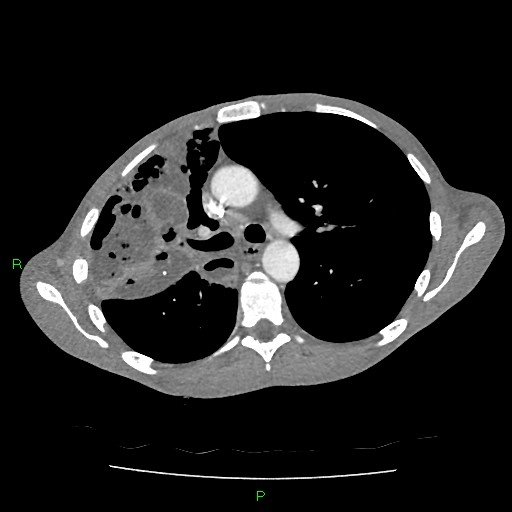 File:Acute right lung abscess (Radiopaedia 34806-36258 Axial C+ arterial phase 71).jpg