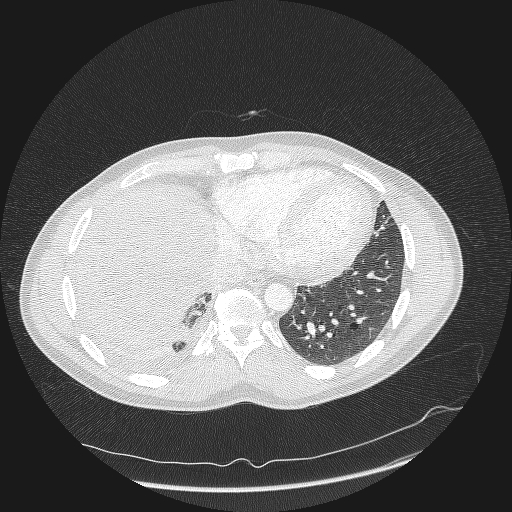 File:Acute segmental pulmonary emboli and pulmonary infarction (Radiopaedia 62264-70444 Axial lung window 148).jpg