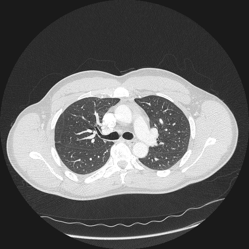 File:Acute segmental pulmonary emboli and pulmonary infarction (Radiopaedia 62264-70444 Axial lung window 65).jpg