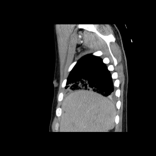 Acute segmental pulmonary emboli and pulmonary infarction (Radiopaedia 62264-70444 Sagittal C+ CTPA 13).jpg