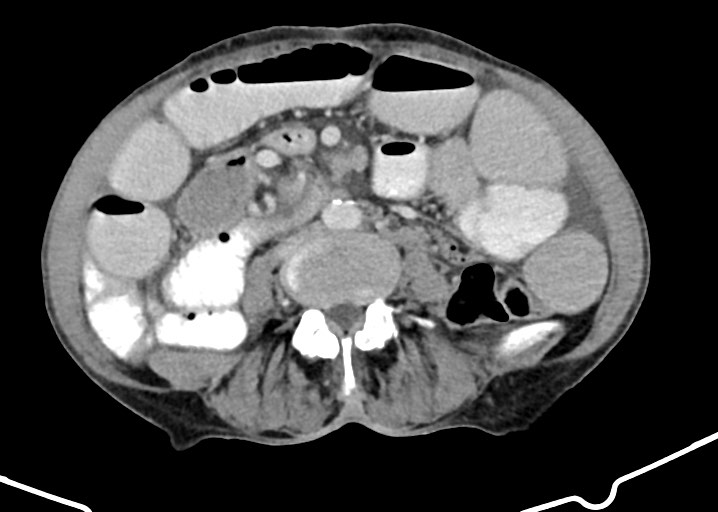Acute small bowel (ileal) volvulus (Radiopaedia 71740-82139 Axial C+ portal venous phase 120).jpg