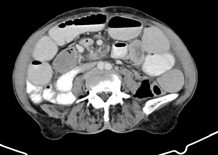 Acute small bowel (ileal) volvulus (Radiopaedia 71740-82139 Axial C+ portal venous phase 123).jpg
