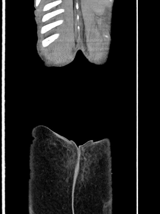 Acute small bowel (ileal) volvulus (Radiopaedia 71740-82139 Coronal C+ portal venous phase 111).jpg