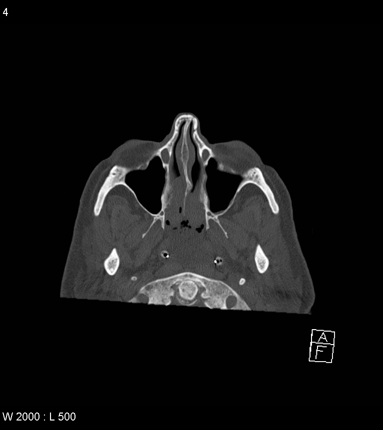 Acute subdural hematoma with myelofibrosis (Radiopaedia 52582-58494 Axial bone window 2).jpg