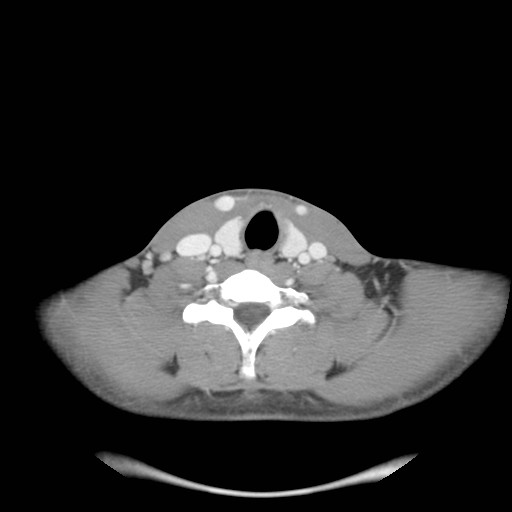 File:Acute submandibular sialadenitis secondary to ductal stone (Radiopaedia 27999-28267 Axial C+ delayed 37).jpg