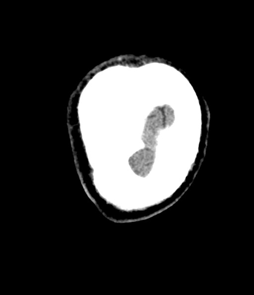File:Acute superior cerebellar artery territory infarct (Radiopaedia 84104-99359 Coronal non-contrast 82).jpg