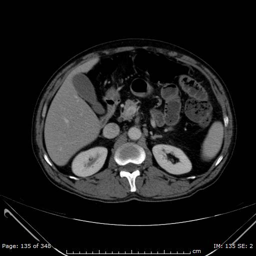 Acute superior mesenteric artery occlusion (Radiopaedia 43636-47060 Axial C+ portal venous phase 13).jpg
