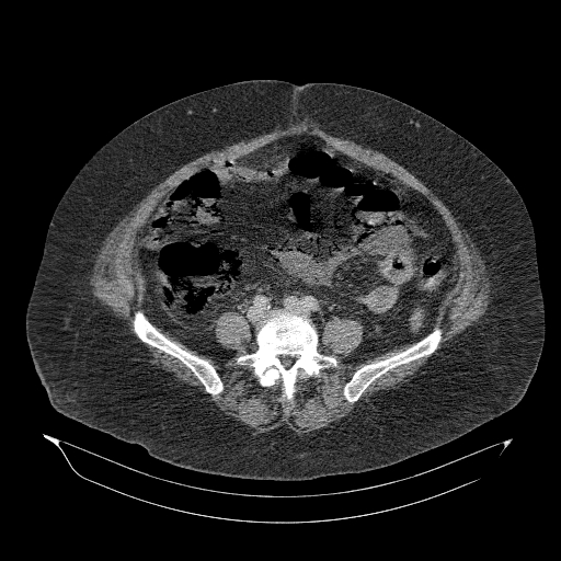 File:Acute superior mesenteric artery occlusion (Radiopaedia 51288-56960 Axial C+ portal venous phase 67).jpg