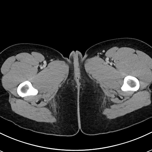 File:Acute uncomplicated appendicitis (Radiopaedia 61374-69304 Axial C+ portal venous phase 148).jpg