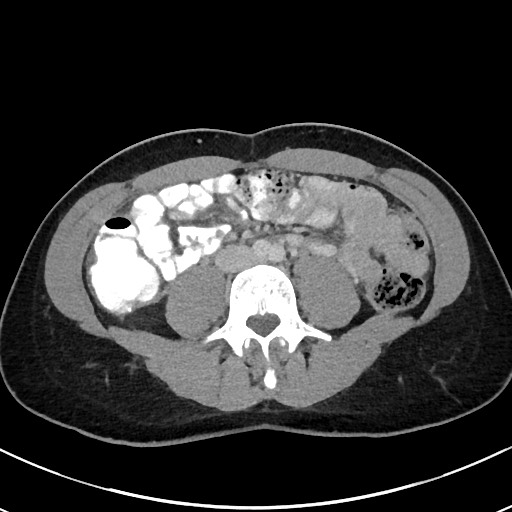 Acute uncomplicated appendicitis (Radiopaedia 61374-69304 Axial C+ portal venous phase 65).jpg