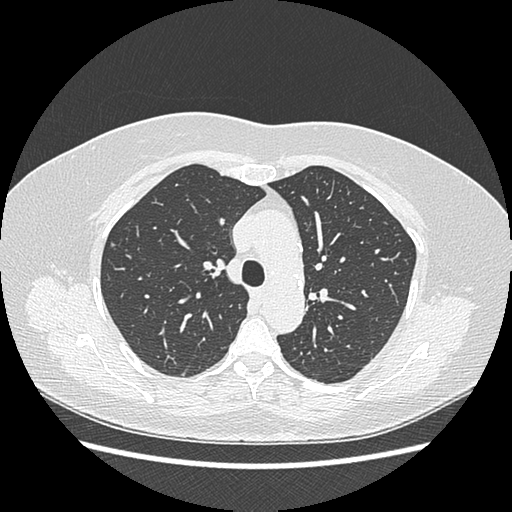 Adenocarcinoma in situ of lung (Radiopaedia 38685-40829 B 76).png