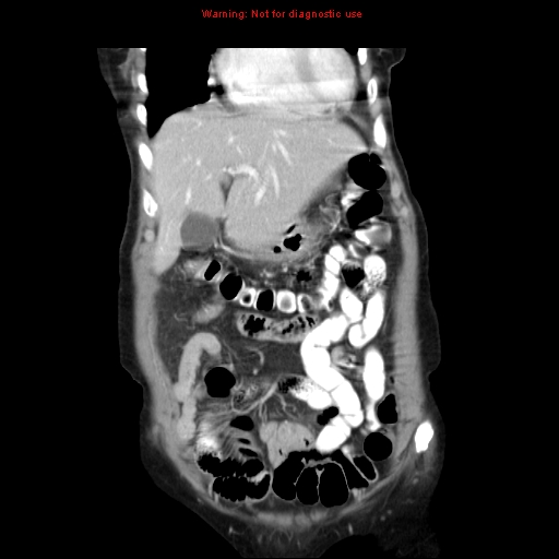 File:Adenocarcinoma of the colon (Radiopaedia 8191-9039 Coronal liver window 12).jpg
