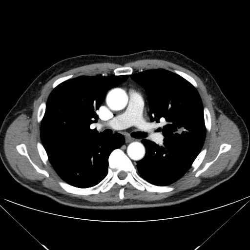 File:Adenocarcinoma of the lung (Radiopaedia 59871-67325 Axial C+ arterial phase 41).jpg