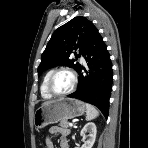 Adenocarcinoma of the lung (Radiopaedia 59871-67325 Sagittal C+ arterial phase 71).jpg