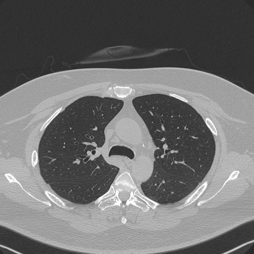 File:Adenoid cystic carcinoma of the trachea (Radiopaedia 49042-54137 Axial lung window 115).jpg