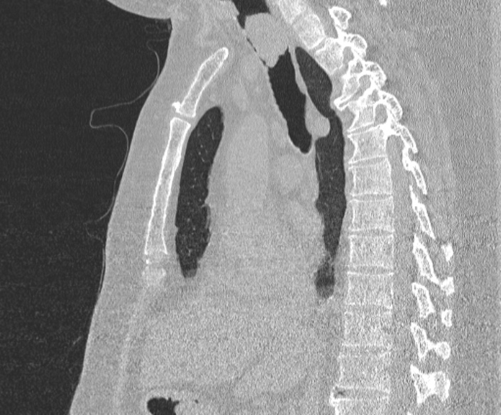 File:Adenoid cystic carcinoma of the trachea (Radiopaedia 49042-54137 Sagittal lung window 226).jpg