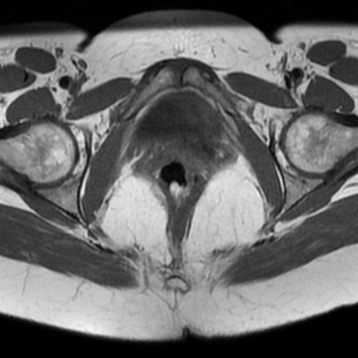 File:Adenoma malignum of cervix (Radiopaedia 66441-75705 Axial T1 15).jpg