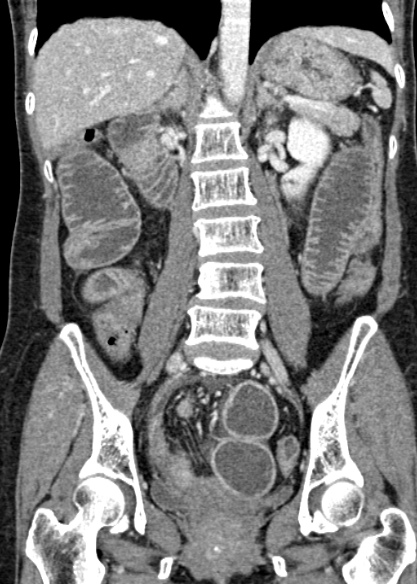Adhesional small bowel obstruction (Radiopaedia 48397-53305 Coronal C+ portal venous phase 211).jpg