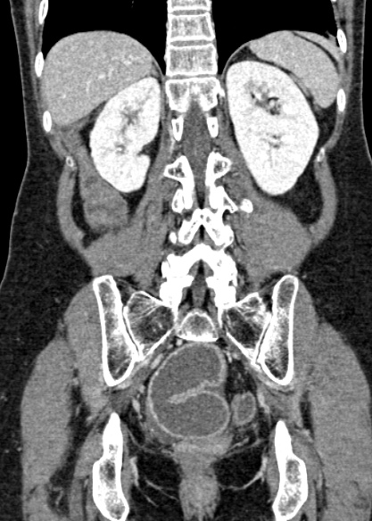 Adhesional small bowel obstruction (Radiopaedia 48397-53305 Coronal C+ portal venous phase 257).jpg