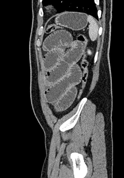 Adhesional small bowel obstruction (Radiopaedia 58900-66131 Sagittal C+ portal venous phase 210).jpg