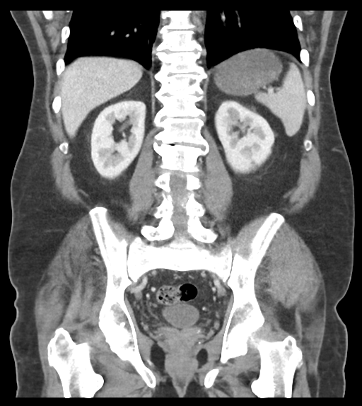 Adhesions within abdominal wall hernia (Radiopaedia 58283-65394 Coronal C+ portal venous phase 49).png