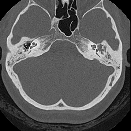 File:Adhesive chronic otitis media (Radiopaedia 14270-14148 Axial bone window 7).jpg